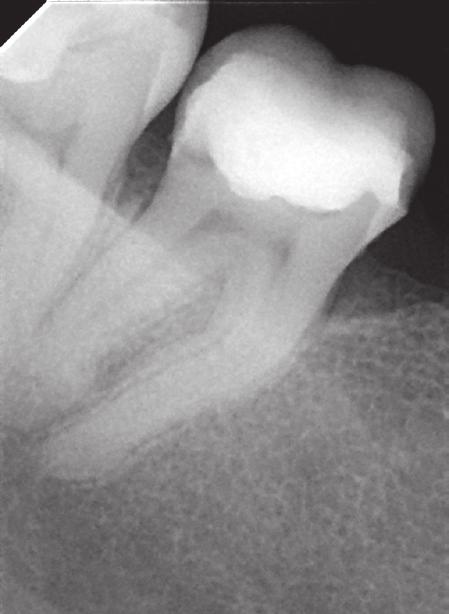 J Stoma 2017; 70, 5 Olczak K. Fig. 5. X-ray of tooth 46 prior to root canal treatment.