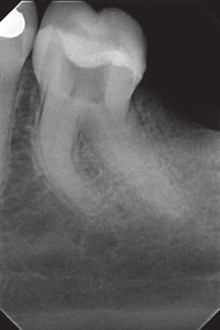 Root canal treatment of teeth with curved root canals J Stoma 2017; 70, 5 Fig. 7. X-ray of tooth 36 prior to root canal treatment. Mesial canals curved in the form of arch / C letter.