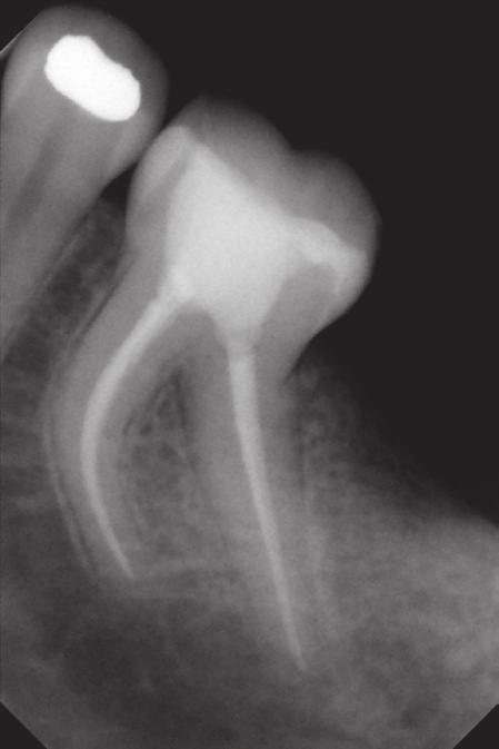 Korzeń i kanał dystalny zagięte w stronę dalszą. Fig. 8. X-ray of tooth 36 after the final preparation and filling root canals.