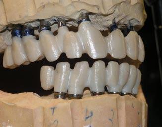 Sprawdzając położenie zębów z przedlewem na każdym etapie, konstrukcja została wymodelowana z żywicy Patter resin.