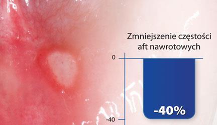Niedobory odporności afty nawrotowe 40% zmniejszenie częstości występowania aft nawrotowych, efektem stosowania: 9 kapsułek BioMarine 570 u 25 pacjentów dr n.