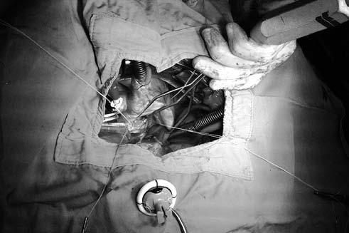 A simple heart valve replacement technique which improves surgical time Introduction Since the first successful prosthetic mitral valve was implanted, there has been a great advance in the heart