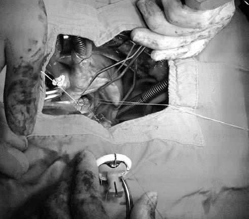 However, most surgeons prefer the classically suggested suturing techniques in which multiple single interrupted sutures are placed in the annulus first and then the sutures are implanted in the