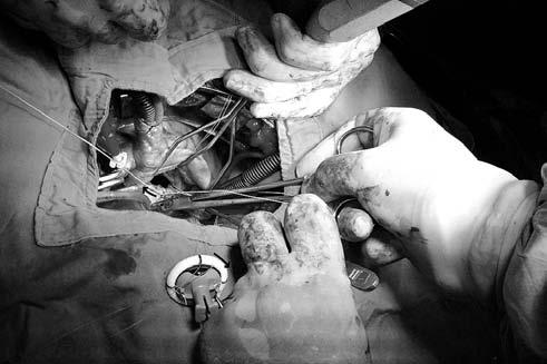 CARDIAC SURGERY Fig. 3. Interrupted sutures passed from the annulus first and then the sewing ring subsequently in a clockwise direction.