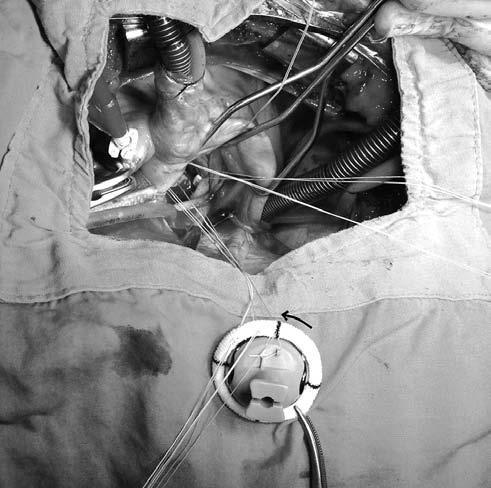 The first quadrant sutures clamped, the valve prosthesis rotated in counterclockwise direction as the arrow indicates Fig. 5.