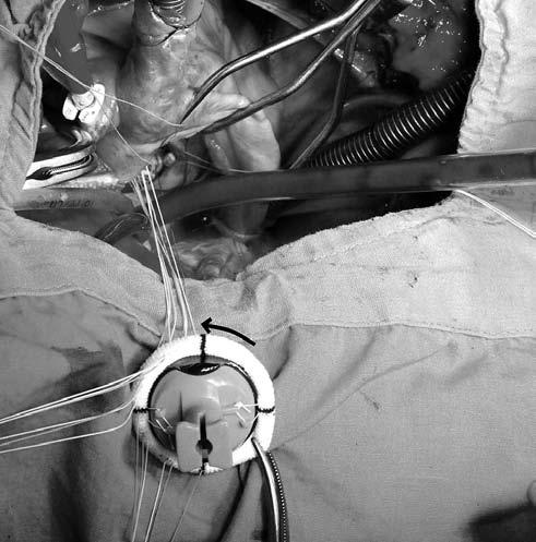 This was repeated for the first three quadrants (Fig. 5). After completion of the third quadrant, the valve was declamped and put to the left side of the surgeon without clamping it (Fig. 6).