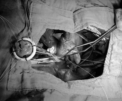 Starting from the posterior annular sutures, the sutures were tied in clockwise direction.