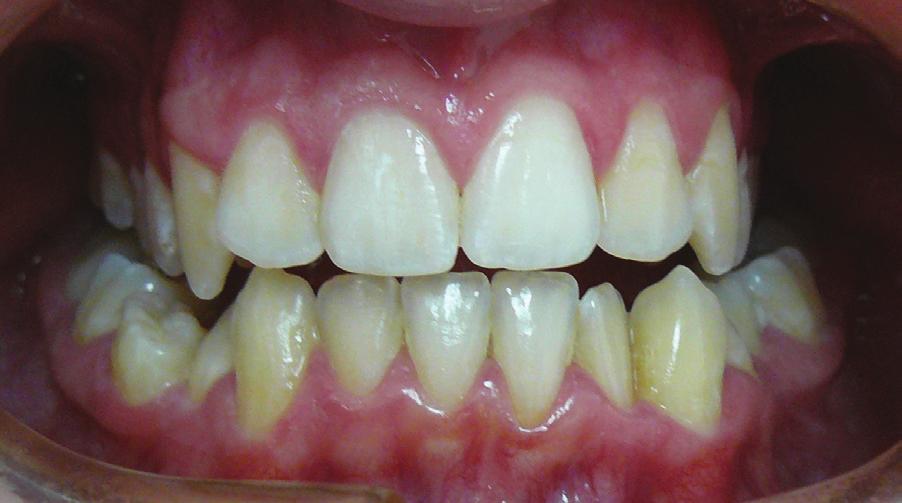 Soft tissue augmentation prior to incisor decompensation in Class III malocclusion... J Stoma 2017; 70, 1 Fig. 1 Baseline status: thin biotype in the area of lower central incisors.