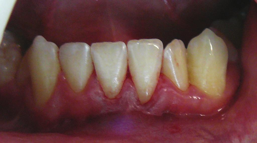 Z cięcia rowkowego odpreparowany tunel nadokostnowy. Fig. 3 SCTG harvesting according to single incision technique. Pobieranie tkanki łącznej w technice pojedynczego cięcia. Fig. 4 Graft matching.