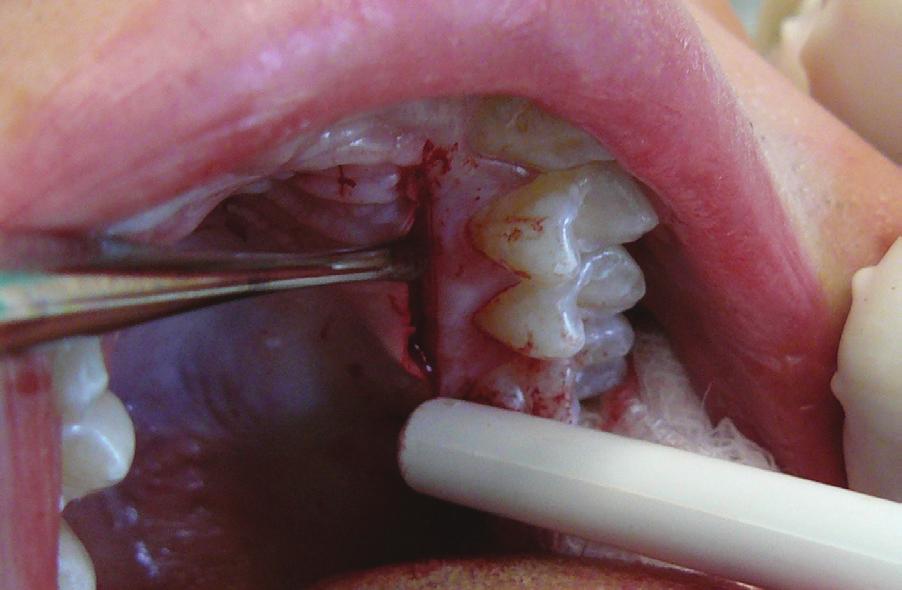 At baseline, the buccal gingiva of central incisors was significantly thinner than that of lateral incisors, 0.54±0.2 mm vs. 0.67±0.12 mm, respectively (p<0.05).