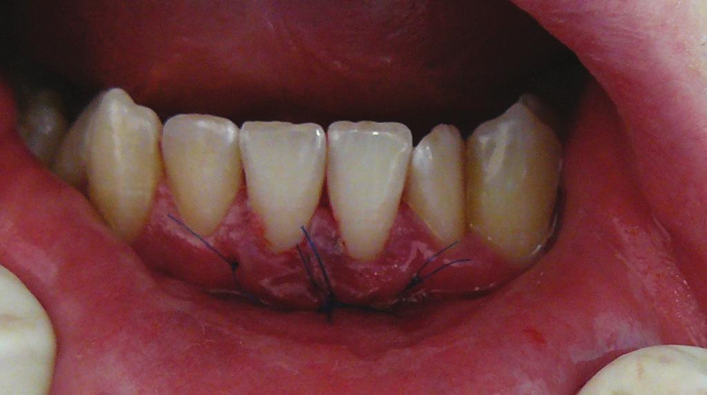 J Stoma 2017; 70, 1 Fig. 5 Graft slipped into the tunnel and stabilized with suture. Wsunięty do tunelu i ustabilizowany przeszczep. Droździk A., Grocholewicz K., Safranow K. Fig. 6 Soft tissue status at ten days after surgery.