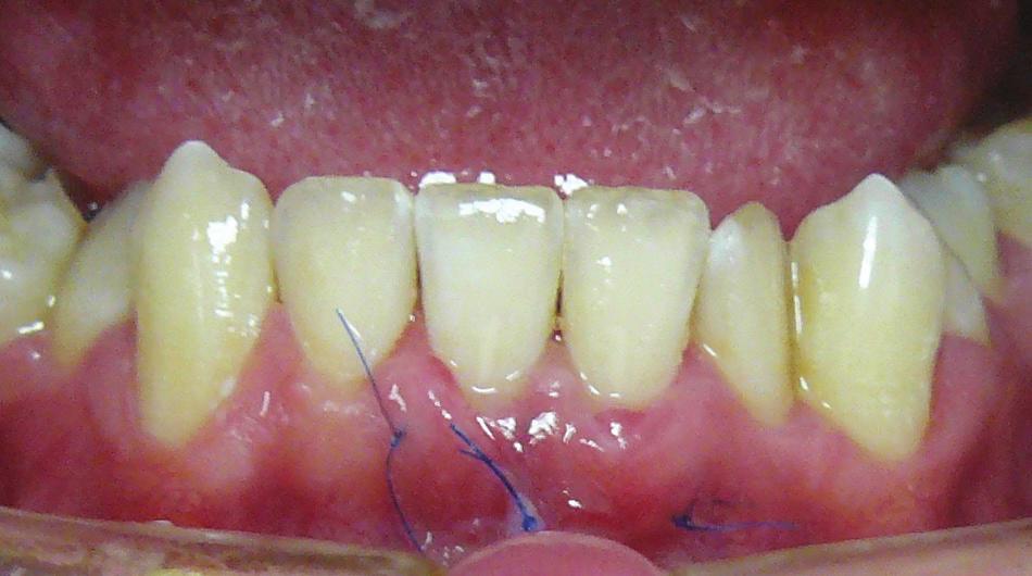 Gojenie rany na podniebieniu 10 dni po zabiegu. outside the cortical plate is a risk factor for gingival recessions.