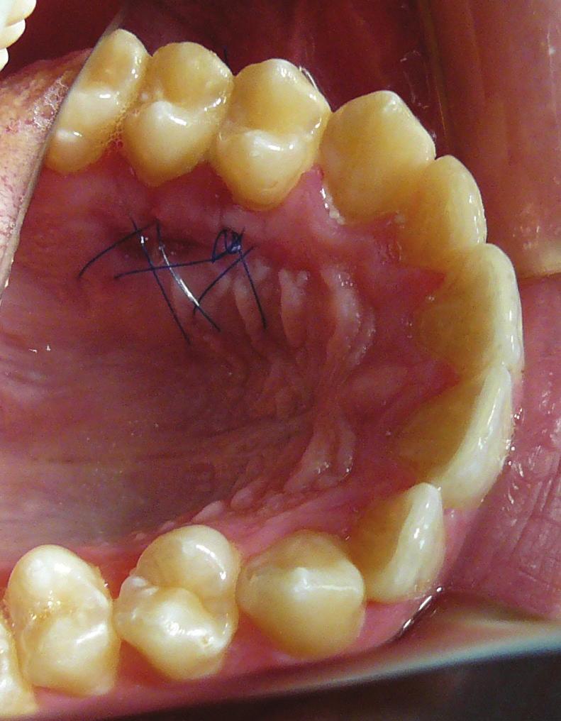 7,8 According to the proposed concept of bony envelope for the lower anterior alveolar process with labial bone plate as its anatomic border, tooth movement should be limited to alveolar bone.