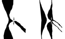 Teoria przydatna w praktyce Anatomia i rozk³ad zmian mia d ycowych bifurkacji têtnic Zgodnie z prawami fizyki, w naczyniach, w których p³ynie ciecz, osad odk³ada siê przede wszystkim w miejscach, w