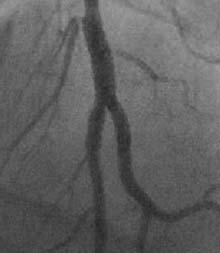 Tylko ultrasonografia wewn¹trznaczyniowa (IVUS) pozwala dok³adnie oceniæ rzeczywist¹ wielkoœæ naczynia.
