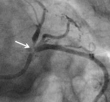 A B Ryc. 3. A ciasne zwê enie pnia lewej têtnicy wieñcowej oraz bli szego odcinka têtnicy zstêpuj¹cej przedniej (strza³ka). B obraz po implantacji stentu Xience Prime 3,5 23 mm.