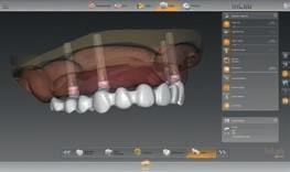 cyrkonu przyklejane do TiBase od Denstply Sirona CAD/CAM projektowane są bezpośrednio lub z góry na dół, co oznacza, że