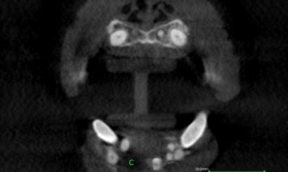 Deformacja okolicy bródkowej i rozległy ubytek sięgający do spojenia kości żuchwy. Fot. 4. Tomogram w projekcji czołowej.