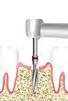 Bio3 implanty suprastruktury zestaw chirurgiczny narzędzia Bio3 IMPLANT PROGRESSIVE Platforma standardowa ø 3.8 ŚREDNICA 3.8 ø 3.2 UWAGA!