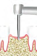 Bio3 IMPLANT ADVANCED Platforma standardowa ø 3.8 ŚREDNICA 3.8 ø 3.2 ATI3.8/8 ATI3.8/10 8 mm 10 mm 11.5 mm 13 mm ATI3.8/11.5 ATI3.