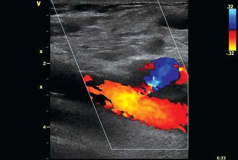 Ryc. 1. Nieuszypułowany tętniak rzekomy prawej tętnicy udowej (badanie wykonane metodą kolo - rowego dopplera) Fig. 1. Right femoral artery pseudoaneurysm without connecting canal (color Doppler examination) Ryc.