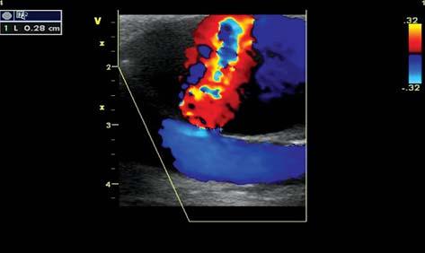 Systolic-diastolic blood flow in the cavity of femoral artery pseudoaneurysm (pulsed wave Doppler) Po 36 godz.