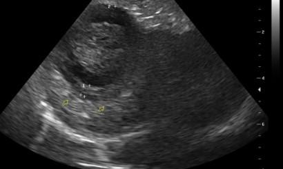 Torbiel śluzowa pęcherzyka żółciowego u psa opis przypadku 1 Torbiel śluzowa pęcherzyka żółciowego jest najczęściej diagnozowaną chorobą tego narządu u psów.
