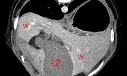 Torbiel śluzowa pęcherzyka żółciowego u psa opis przypadku 5 Fot. 5. Tomogram, przekrój na tym samym poziomie co fot. 4. Obraz po podaniu dożylnym środka cieniującego, faza tętniczo-wrotna.