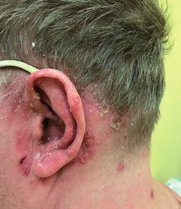 Ryc. 1. Łuszczyca za uszami i na małżowinie usznej. (ang. scalp dy se sthe sia) [5].