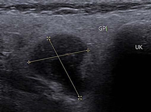 Ryc. 1. Badanie USG w trybie B-mode pierwszego guza znajdującego się w dolnym biegunie prawej ślinianki przyusznej (przypadek 1). GP ślinianka przyuszna, UK żuchwa Ryc. 2.