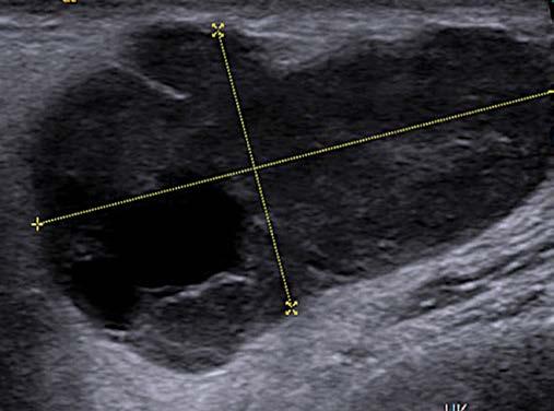 W przypadku trudności w ocenie wymiarów guza za pomocą ultrasonografii lub u pa-cjentów, u których guz zlokalizowany jest w płacie głębokim ślinianki, duże znaczenie ma badanie MRI.