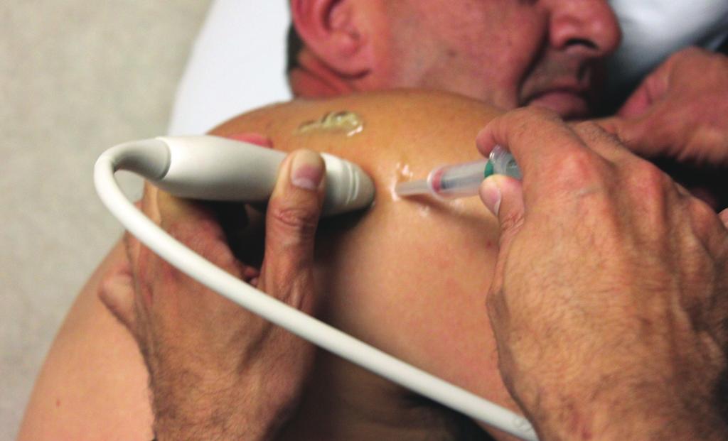 [Figure [Rycina 4a] Położenie Transducer głowicy and needle i orientacja orientation igły przy for GHJ wykonywaniu wstrzyknięć do stawu ramiennego w płaszczyźnie podłużnej (in-plane).