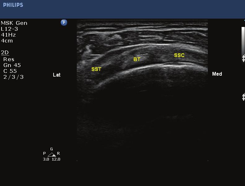 [Figure 8] Ultrasound image of the rotator cuff interval. [Rycina 8] Ultrasonograficzny obraz interwału rotatorów.