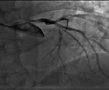 Obraz pnia głównej lewej tętnicy wieńcowej (GLTW) po NTG i.