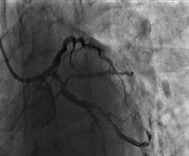 Postdylatacja NC Solarice 4,5 8 mm/18 atm 1F.