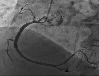 IVUS (intravascular ultrasound) ultrasonografia wewnątrzwieńcowa, GPZ gałąź przednia