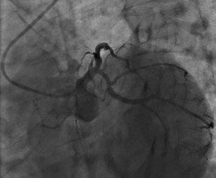 LTW dobry angiograficzny efekt PCI GLTW Rycina 3A D.