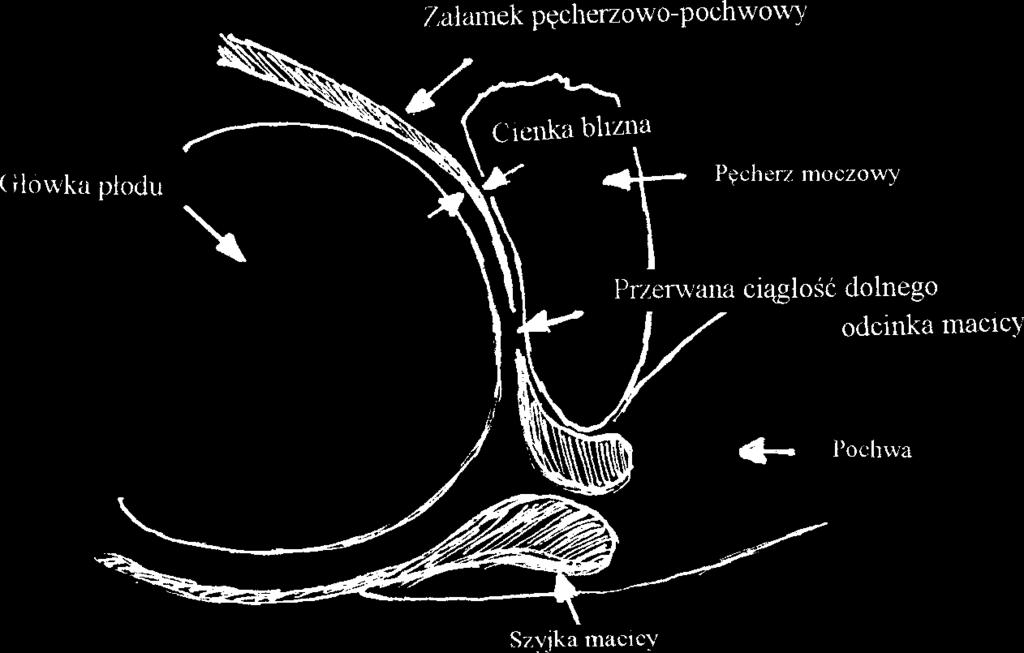 częstość dehiscencji wynosiła 100% (33) (ryc.3,4.