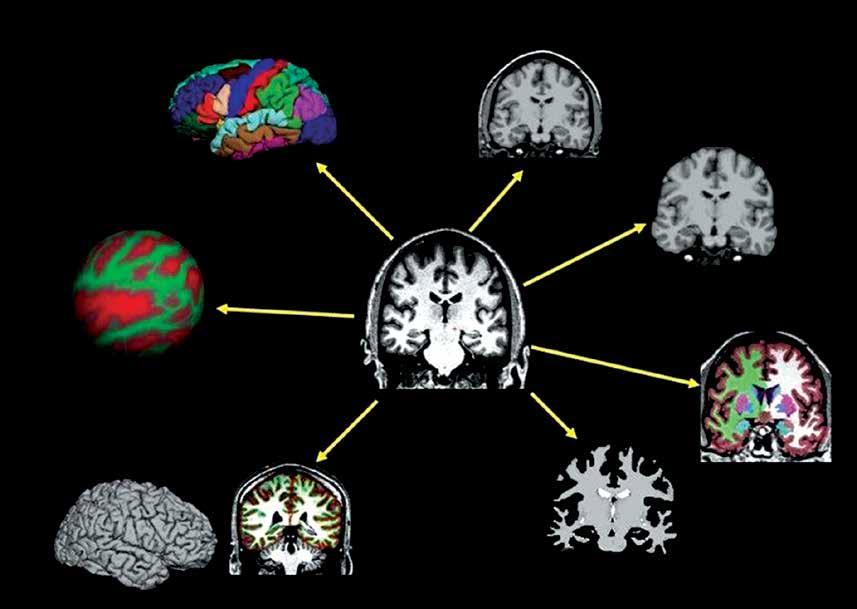 Ocena zaniku kory mózgowej w chorobach neurodegeneracyjnych oraz wybranych chorobach neurologicznych metody oceny i znaczenie w diagnostyce Jednym z najbardziej rozpowszechnionych na świecie