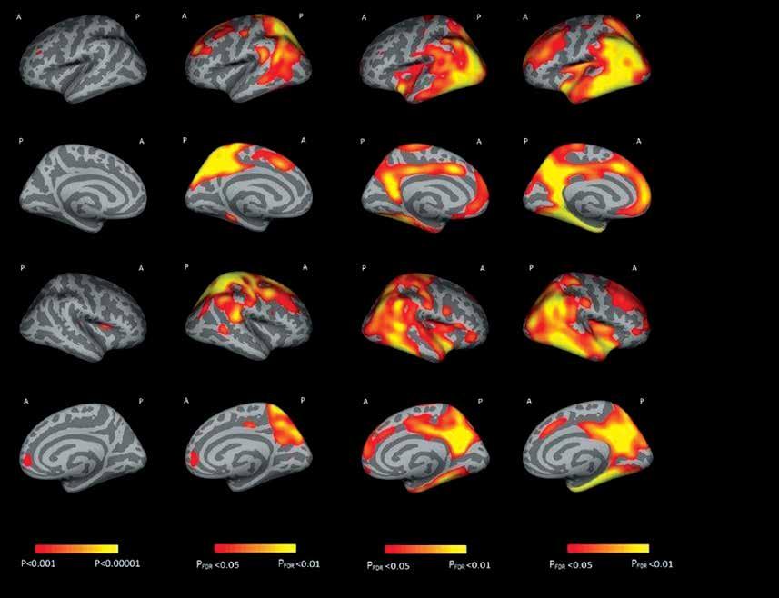Ocena zaniku kory mózgowej w chorobach neurodegeneracyjnych oraz wybranych chorobach neurologicznych metody oceny i znaczenie w diagnostyce Widok od strony lewej Widok w linii przyśrodkowej lewej