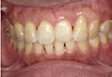 Zdjęcia wewnątrzustne w odcinku przednim: a) przed leczeniem ortodontycznym, b) po leczeniu ortodontycznym, c) po 6 miesiącach od chirurgicznego leczenia przyzębia, d) po
