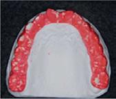 4a 4b 4c Ryc. 4. Wyniki badania za pomocą Brux Checker: a) przed leczeniem ortodontycznym, b) tuż przed zdjęciem aparatu ortodontycznego, c) oraz po 2 latach retencji Fig. 4. Brux Checker findings: