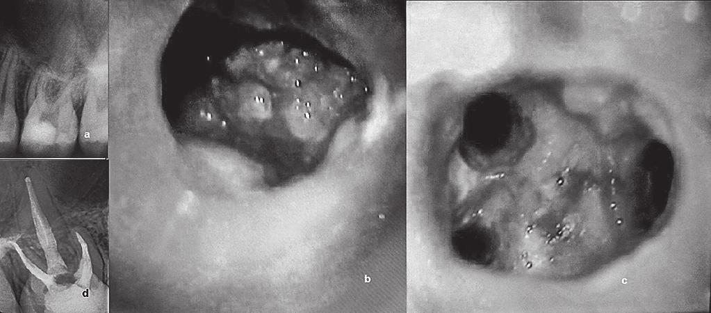 Denticles of the pulp chamber diagnostics and management. Case studies status of the tooth after trepanation was performed (Fig. 4a).