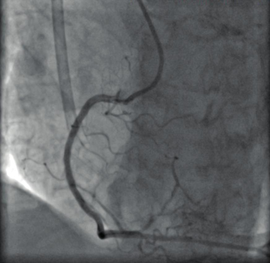 Przy przyjęciu do Kliniki pacjent był w stanie ogólnym dość dobrym, stabilny hemodynamicznie, RR 157/102 mmhg, w zapisie EKG stwierdzono rytm zatokowy miarowy 94/min oraz obniżenia odcinka ST w