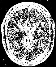 (a) Errors (φ = 0.0) (b) Errors (φ = 0.06) (c) Errors (φ = 0.10) (d) Result (φ = 0.14) Rysunek 6-2: Błędy w segmentacji dla warstwy #90 6.