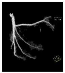 Tomografia spiralna jest używana w angiografii (CTA CT angiography), technice umożliwiającej obrazowanie dużych naczyń krwionośnych, która