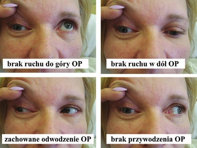RYCINA 1 Prawe oko w pozycji pierwotnej ustawione do dołu i na zewnątrz. Opis przypadku 48-letnia kobieta zgłosiła się do lekarza rodzinnego z powodu niespecyficznych bólów głowy.