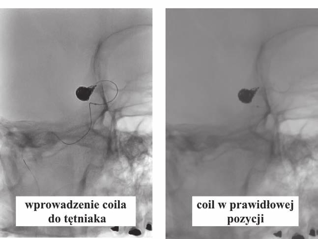 nionego coilem (ryc. 4B). Zabieg był skuteczny, uzyskano potwierdzone radiologicznie zamknięcie światła tętniaka.