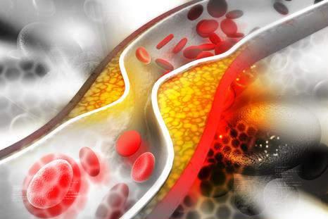 Wrodzona hipercholesterolemia - ma dziedziczenie autosomalnie dominujące i jest związana z różnymi defektami genu receptor LDL. Znajduje się on na chromosomie 19.