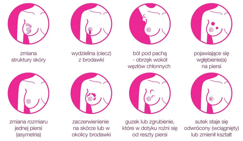 Objawy raka piersi Guz wyraźnie różniący się od otaczających tkanek Nieostro odgraniczone zgrubienie nieobecne w drugiej piersi Zmiana kształtu lub powiększenie piersi W zaawansowanych